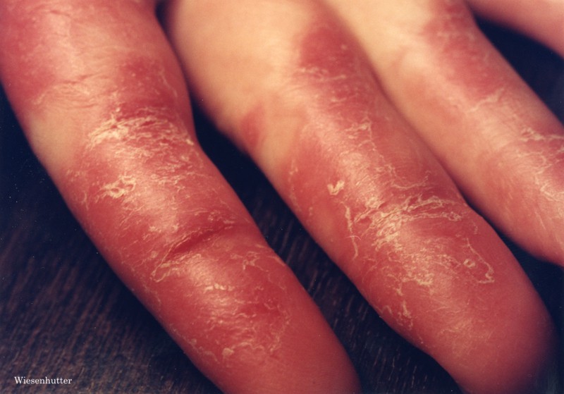 Lupus Hand Rash