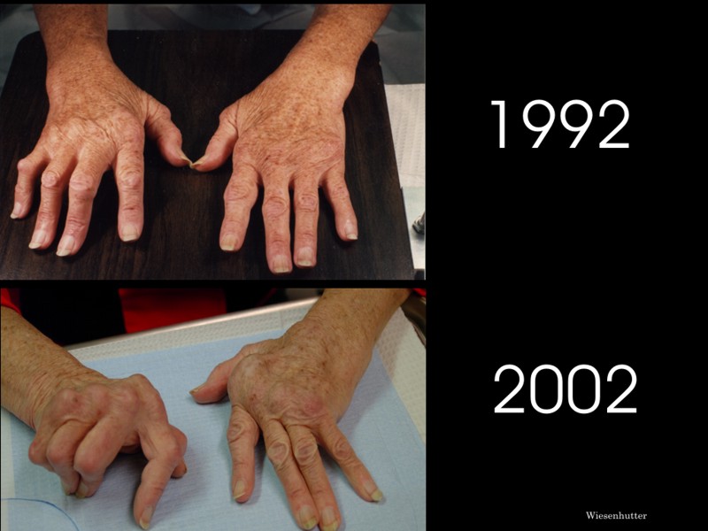 korai stádiumú rheumatoid arthritis